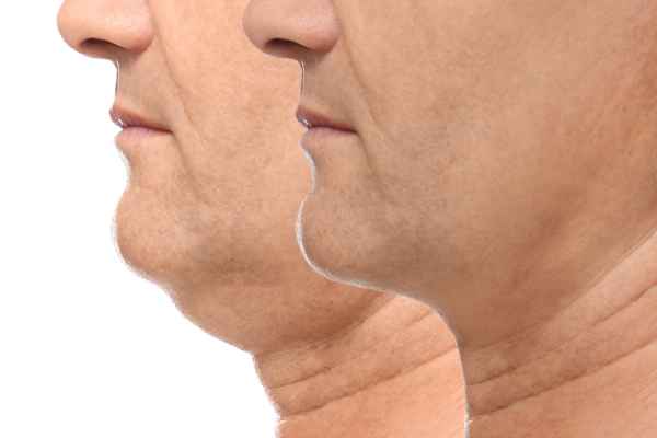 HIFU - Breakthrough in Anti - ageing 2 hifu results Devizes