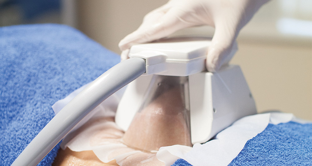 How Fat Freezing and HIFU Work Together? 2 Multiple Areas in One Session HIFU and Fat Freezing Devizes