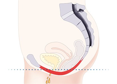 Pelvic-Floor Muscle Repair 5 Pelvic floor muscles Devizes
