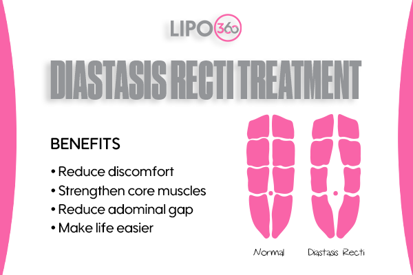 Revolutionising Muscle Repair: The Power of LIPO360 Body Sculpt Post-Injury 5 diastasis recti treatment Devizes