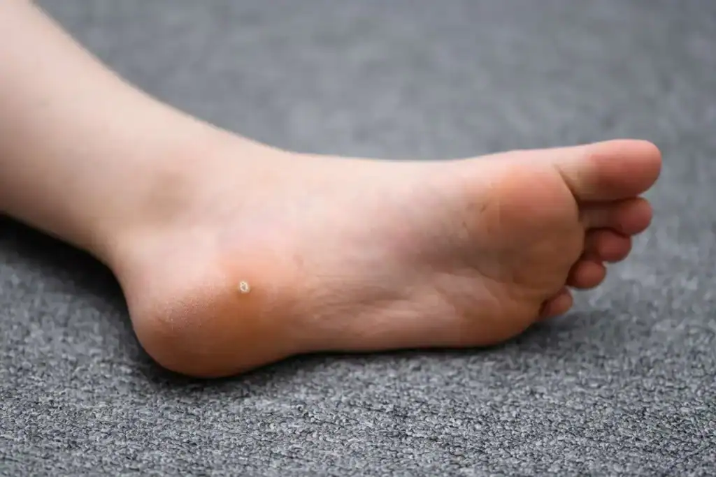 Cryotherapy For Warts And Also Verrucas 2 Image of verruca on the bottom of the foot that able to be treated with Cryotherapy Devizes