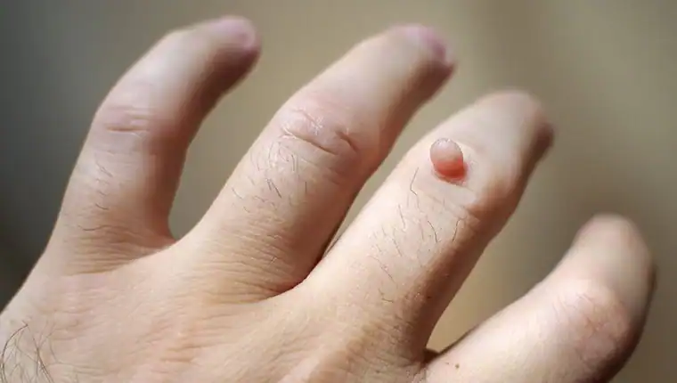 Image of blemish that Cryotherapy Devizes can remove with Lipo 360.