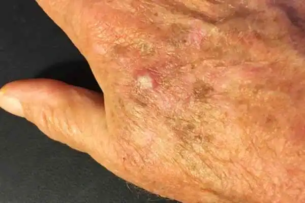 Cryopen For Actinic Keratoses 1 Image of Actinic keratoses Devizes on a person hand