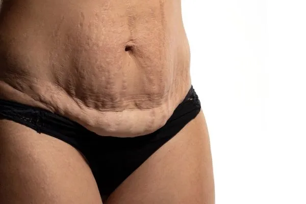 The science behind skin tightening Devizes picture of a woman's sagging skin on the stomach